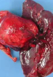SOLID PSEUDOPAPILLARY TUMOR