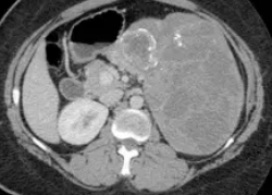 SOLID PSEUDOPAPILLARY TUMOR 