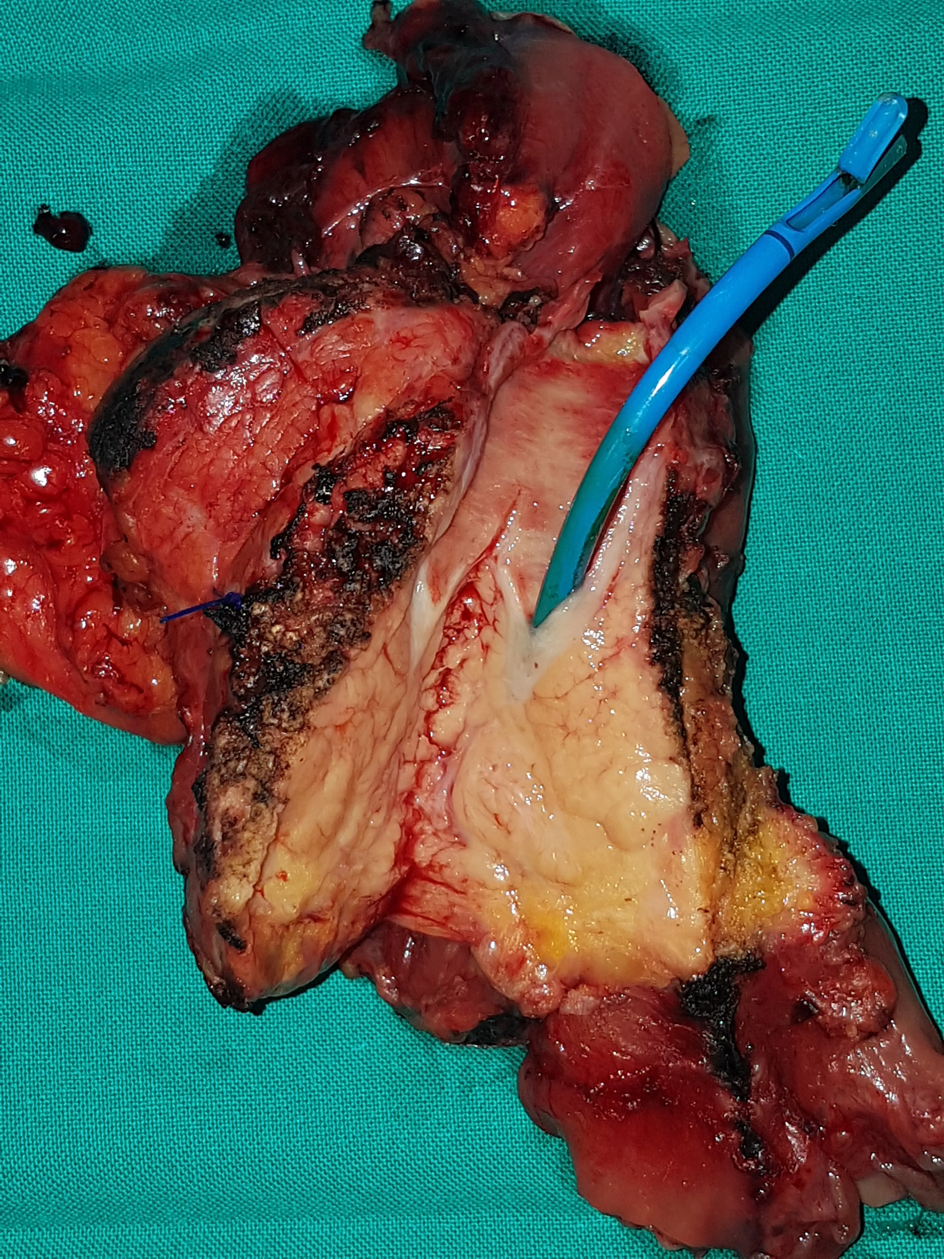 CA HEAD OF PANCREAS