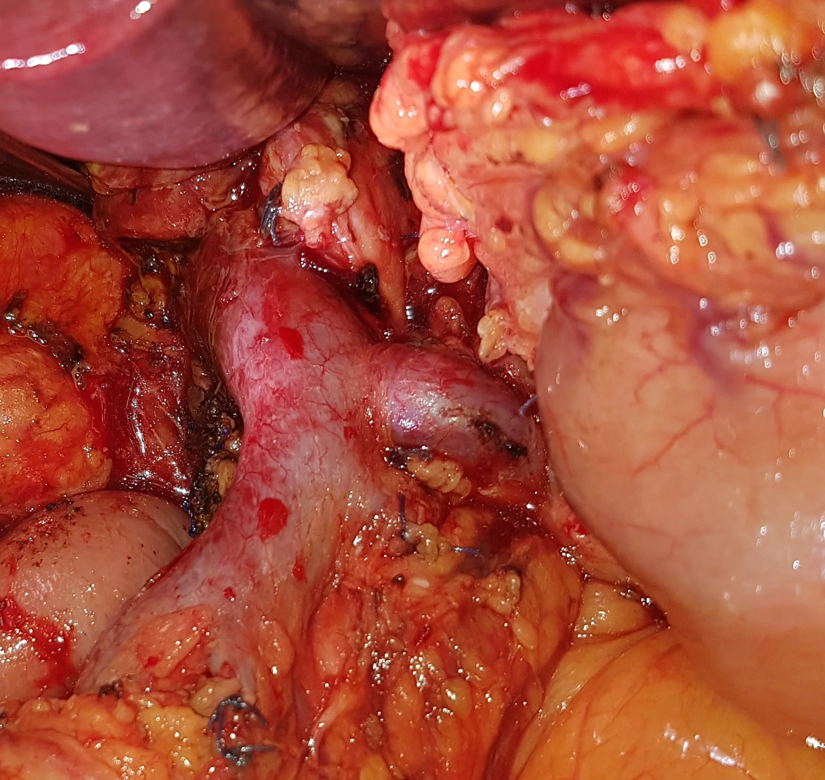 CONFLUENCE OF SUPERIOR MESENTERIC AND SPLENIC VEINS