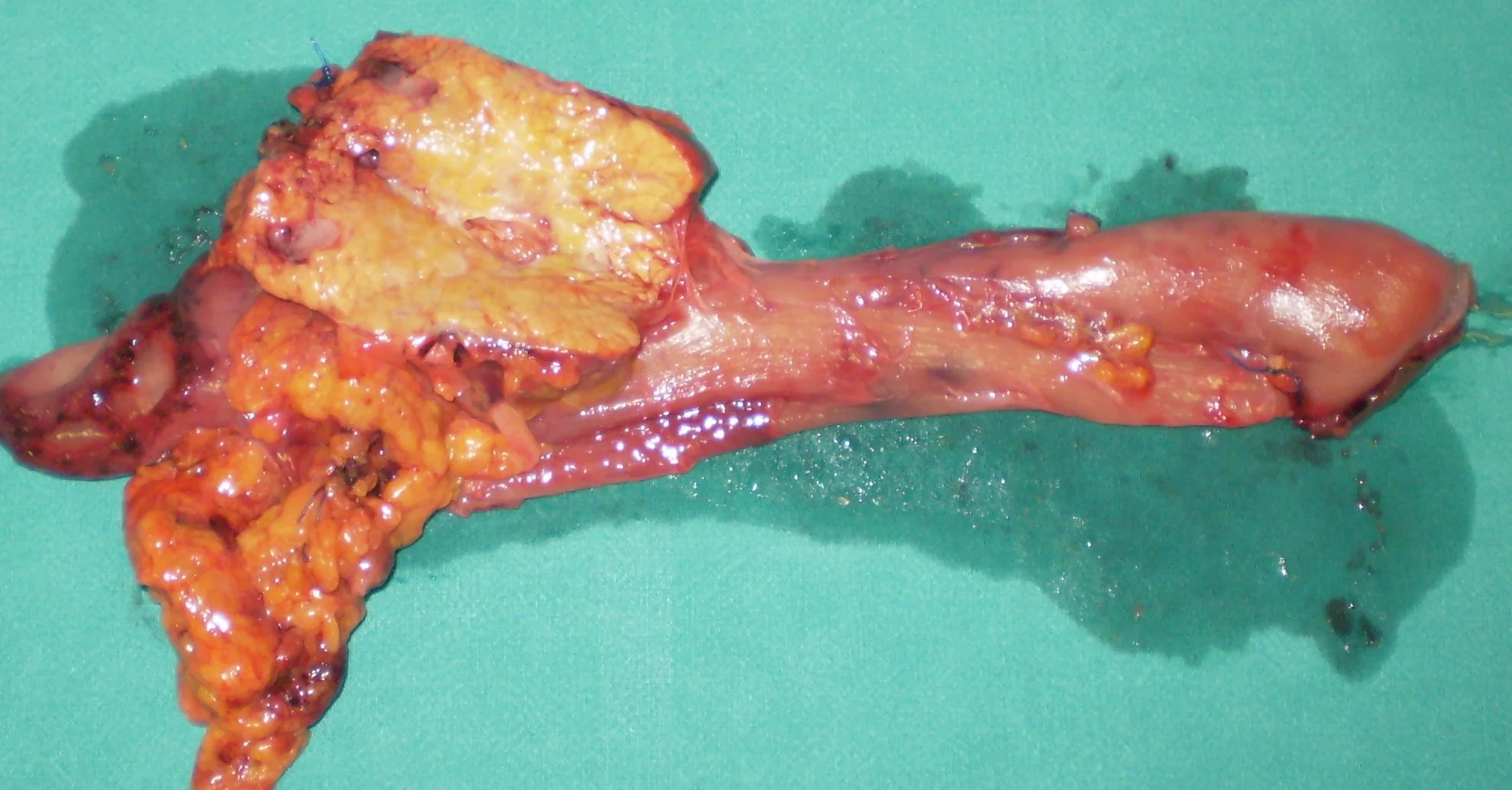 CA HEAD OF PANCREAS