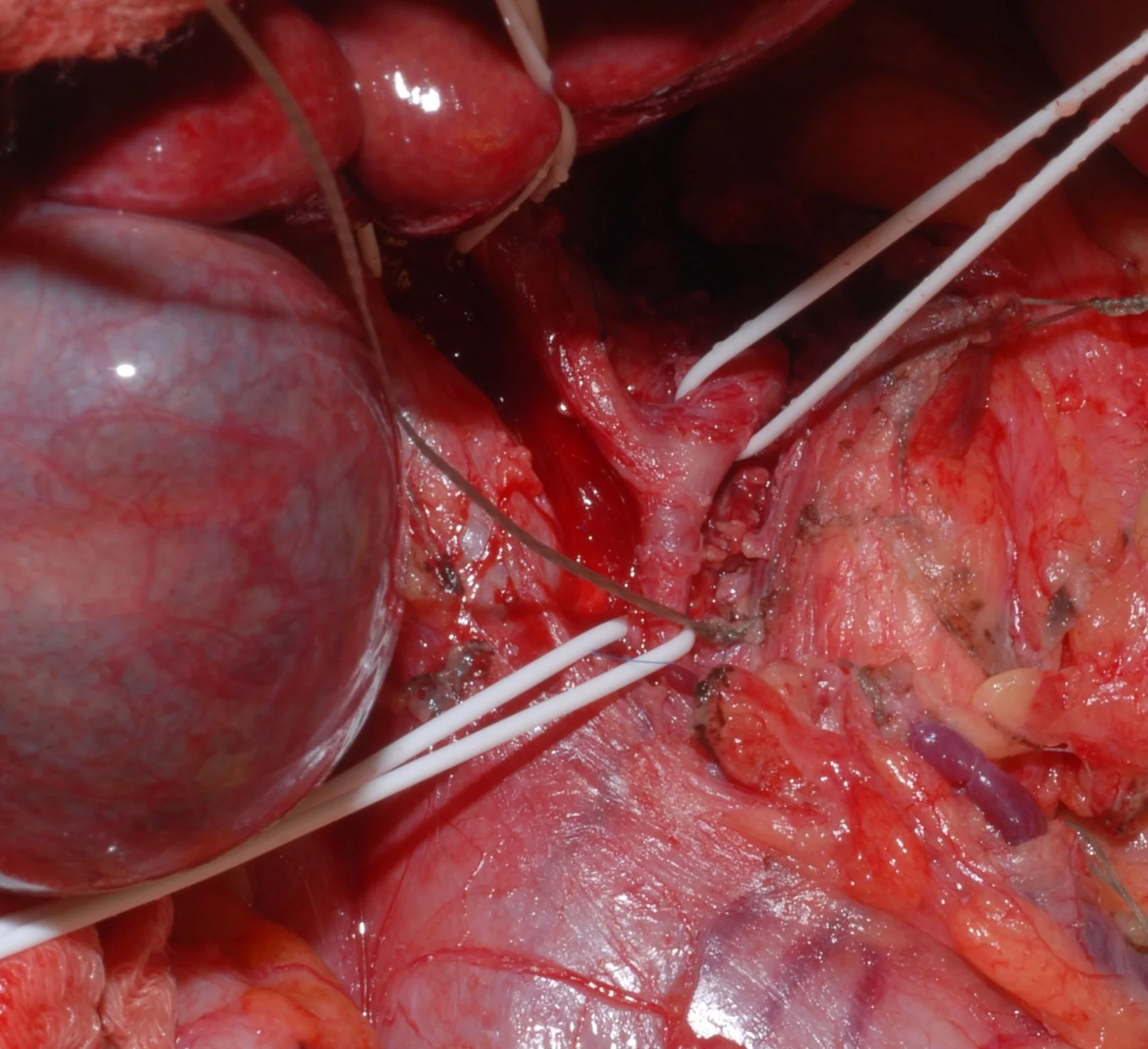 HEPATOGASTRIC LIGAMENT LYMPHADENECTOMY