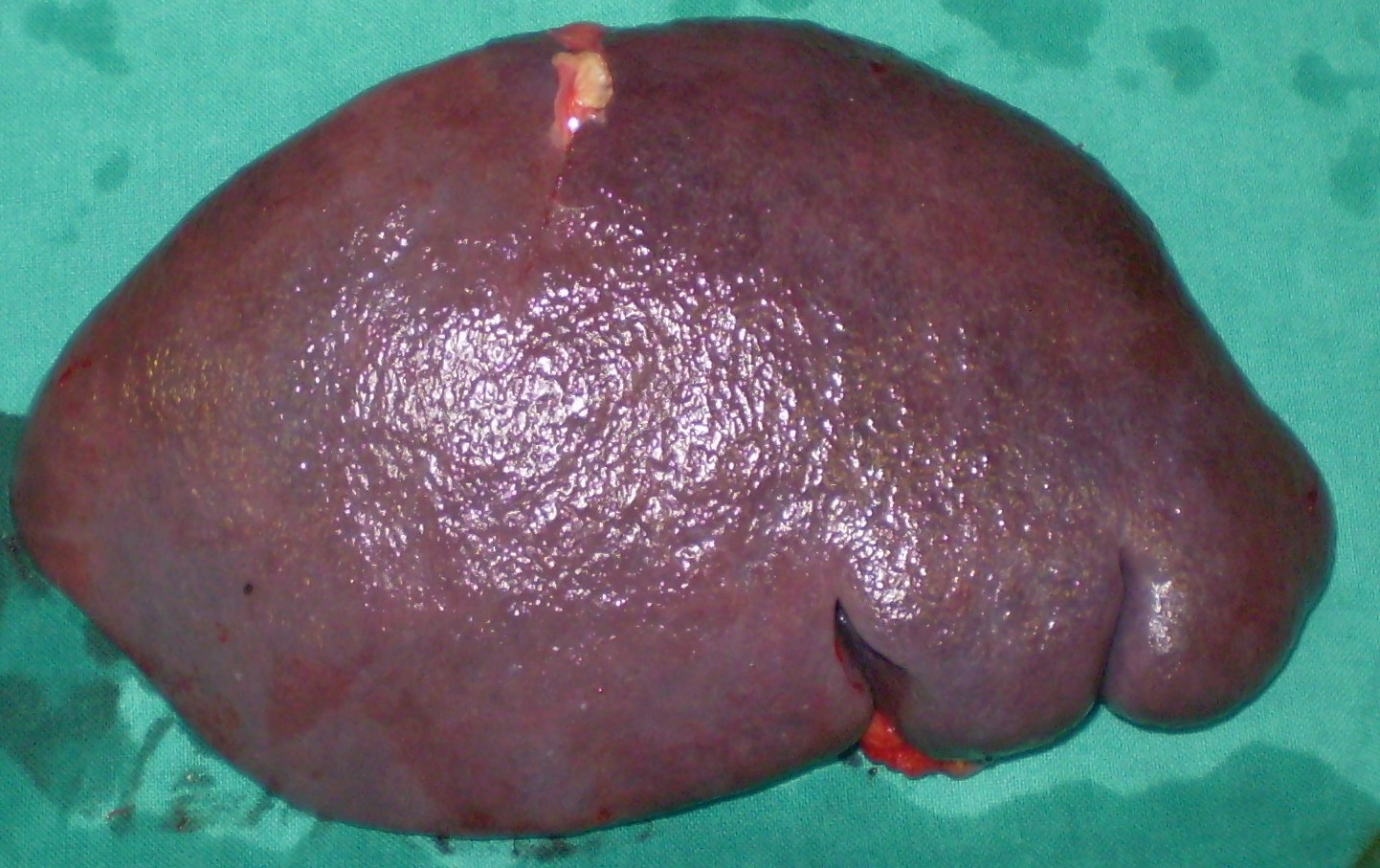 IDIOPATHIC THROMBOCYTOPENIC PURPURA