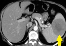 SPLENIC PSEUDOTUMOR