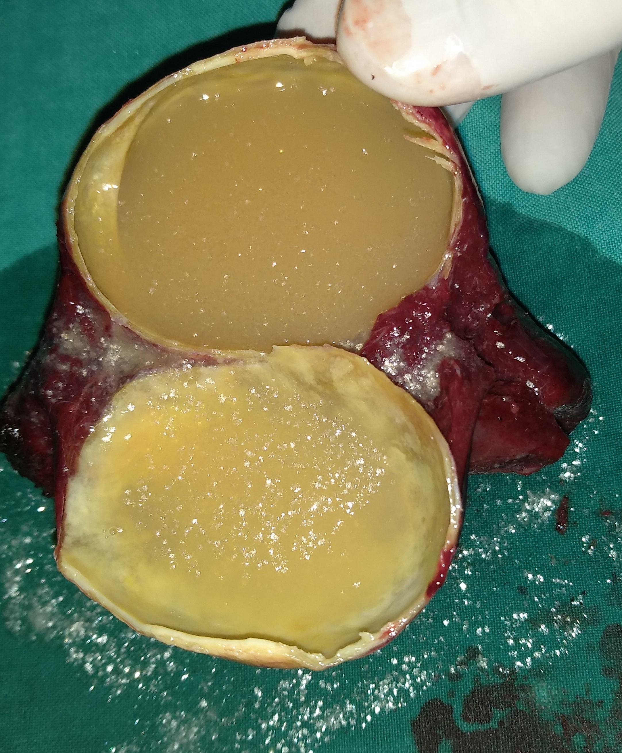 SPLENIC CYST