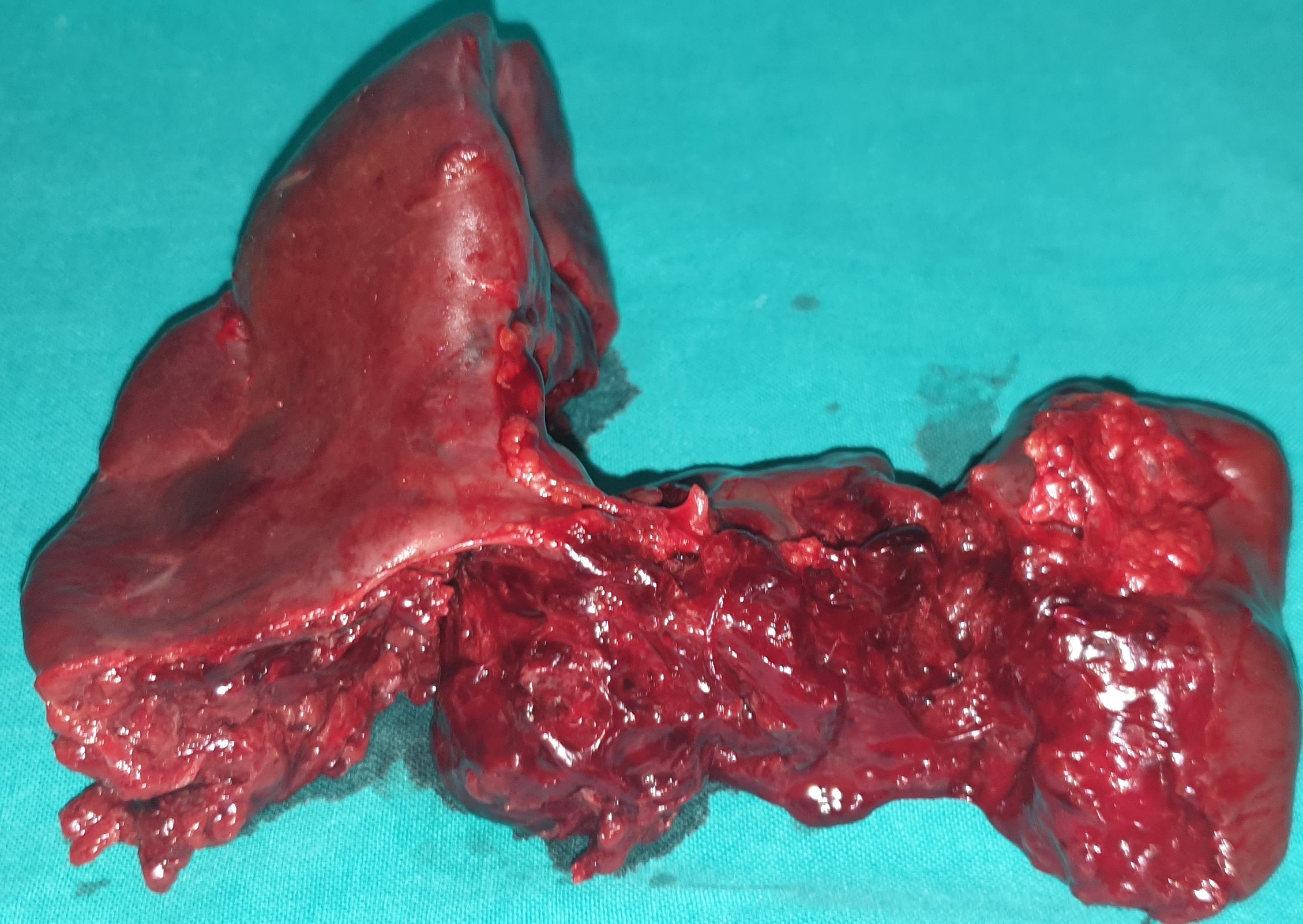 TRAUMATIC SPLENIC RUPTURE