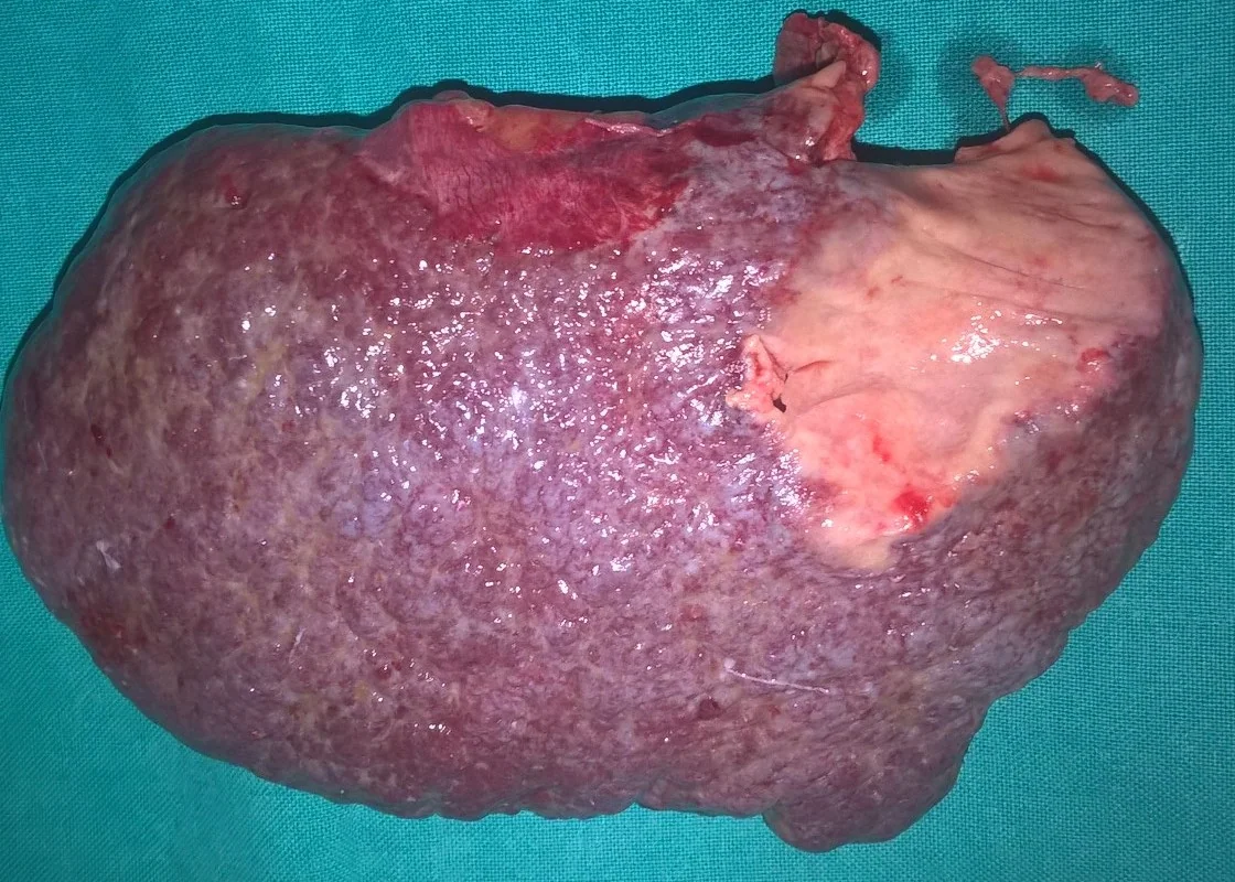 SPLENIC ABSCESS