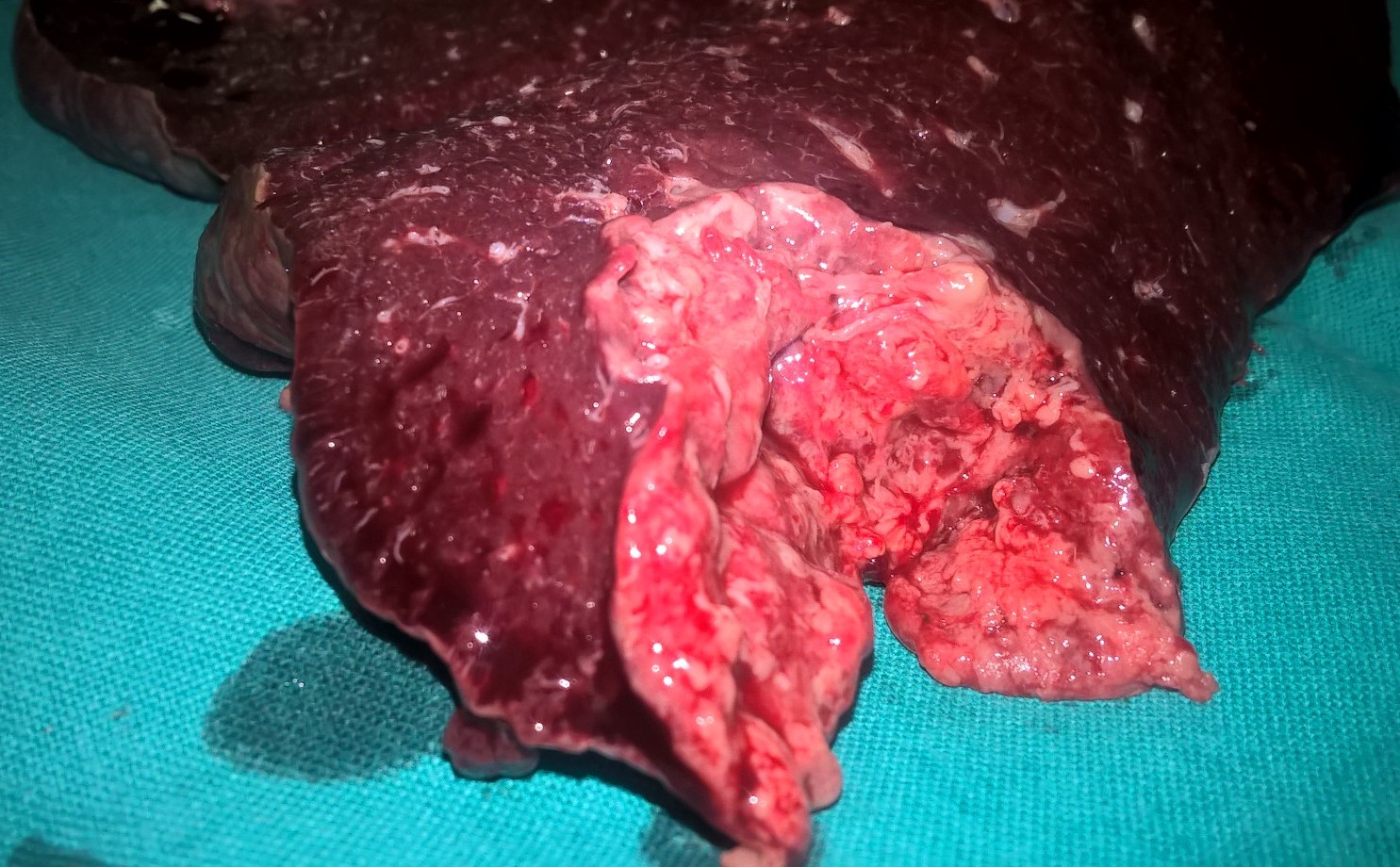 SPLENIC ABSCESS