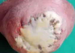 EPITHELIAL SPLENIC CYST