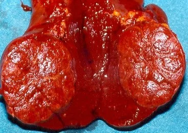 SPLENIC HAMARTOMA