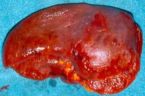 SPLENIC HAMARTOMA - SPLENECTOMY