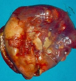 EPITHELIAL SPLENIC CYST
