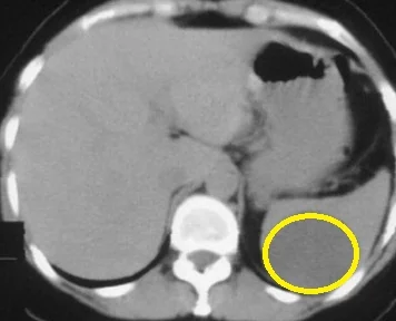 EPIDERMOID SPLENIC CYST