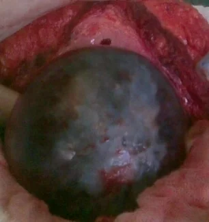 EPIDERMOID SPLENIC CYST