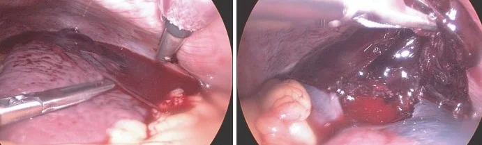 SPLENIC RUPTURE - MALARIA