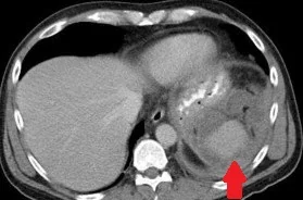 PERISPLENIC ABSCESS