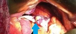SPLENIC HYPOPLASIA