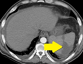 SPLENIC INFARCT