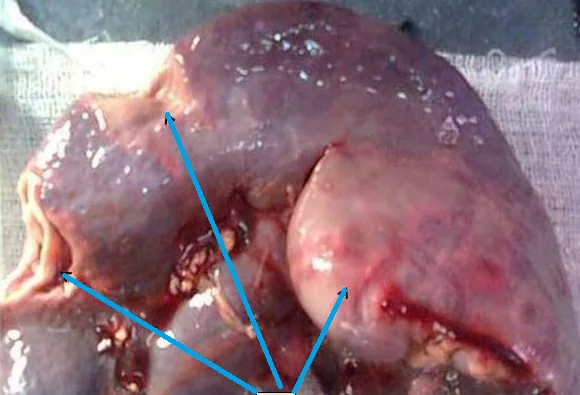 SPLENIC THYPHOID ABSCESSES