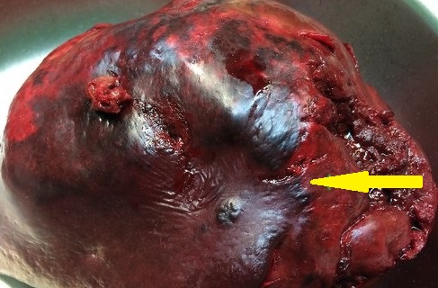 SPLENIC ANGIOSARCOMA