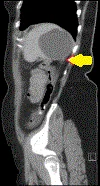 SPLENIC CYST RUPTURE