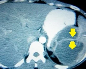 SPLENIC HYDATIDOSIS