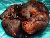 SPLENIC HYDATIDOSIS