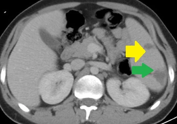 SPLENIC INFARCTS - BRUCELLOSIS