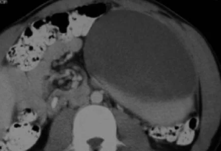 SPLENIC PSEUDOCYST