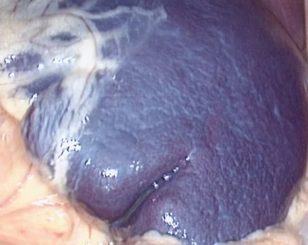 SPLENOMEGALY - SPHEROCYTOSIS