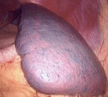 SPLENOMEGALY