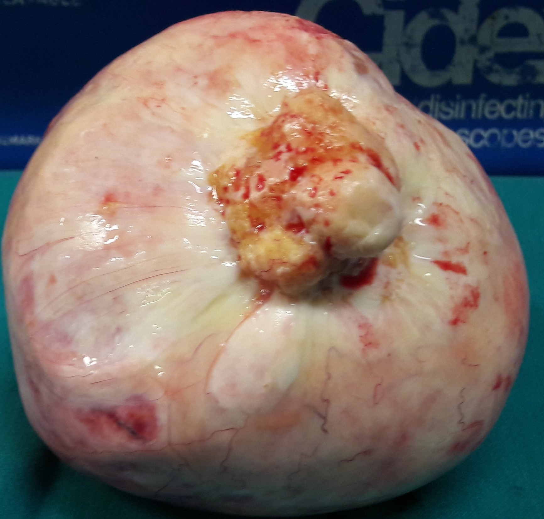 OVARIAN CARCINOMA