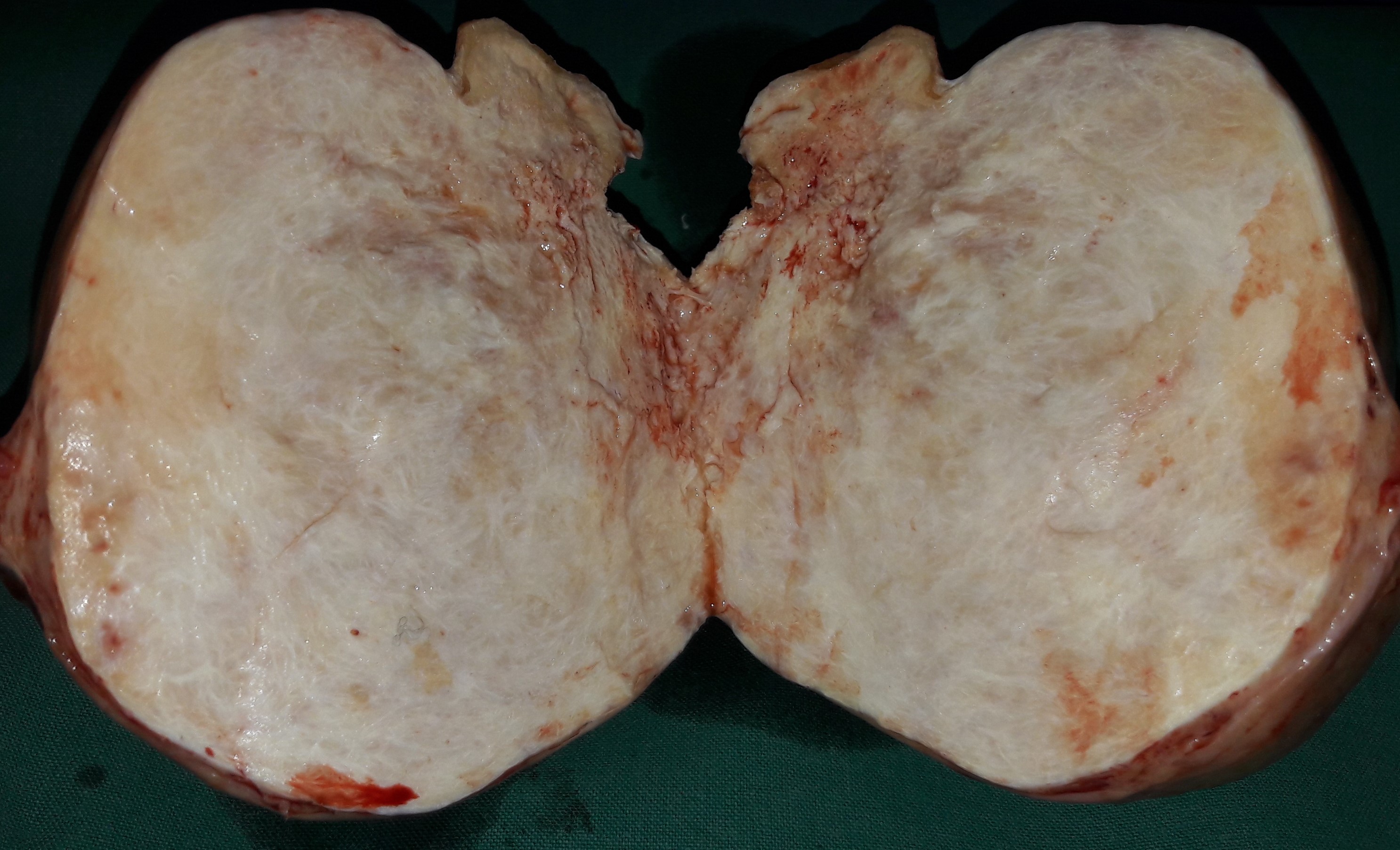 OVARIAN CARCINOMA