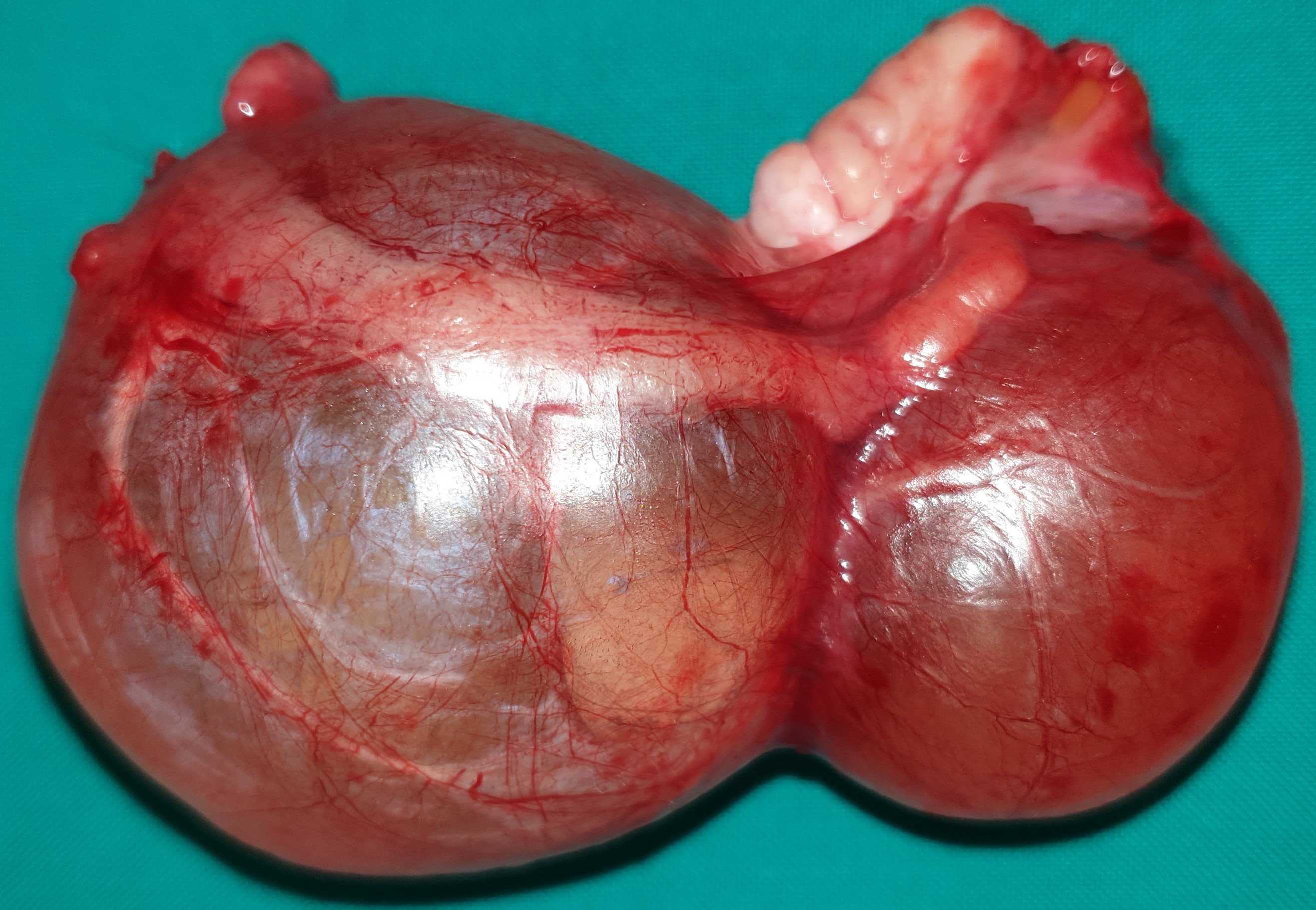 OVARIAN CYSTADENOMA