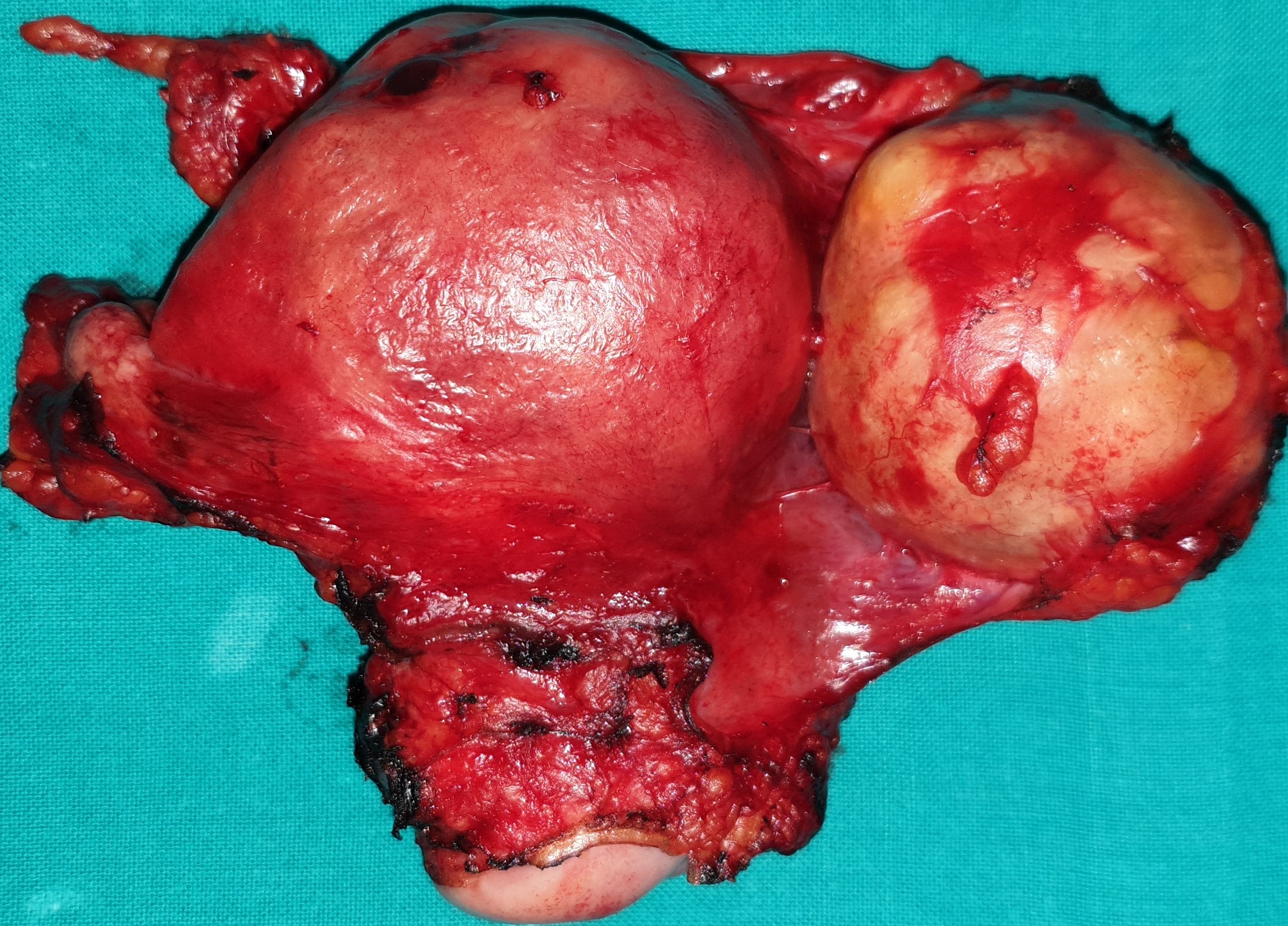 OVARIAN CARCINOMA