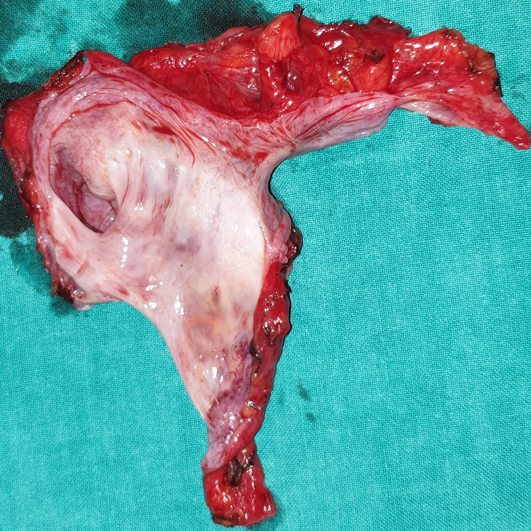 OVARIAN CYSTADENOMA