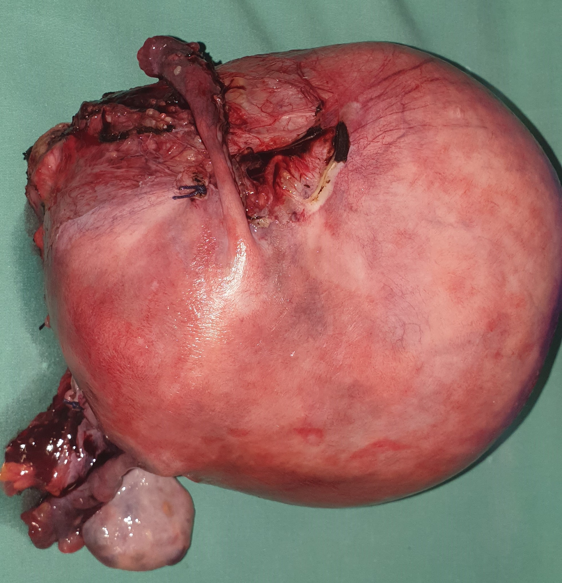 TOTAL HYSTERECTOMY