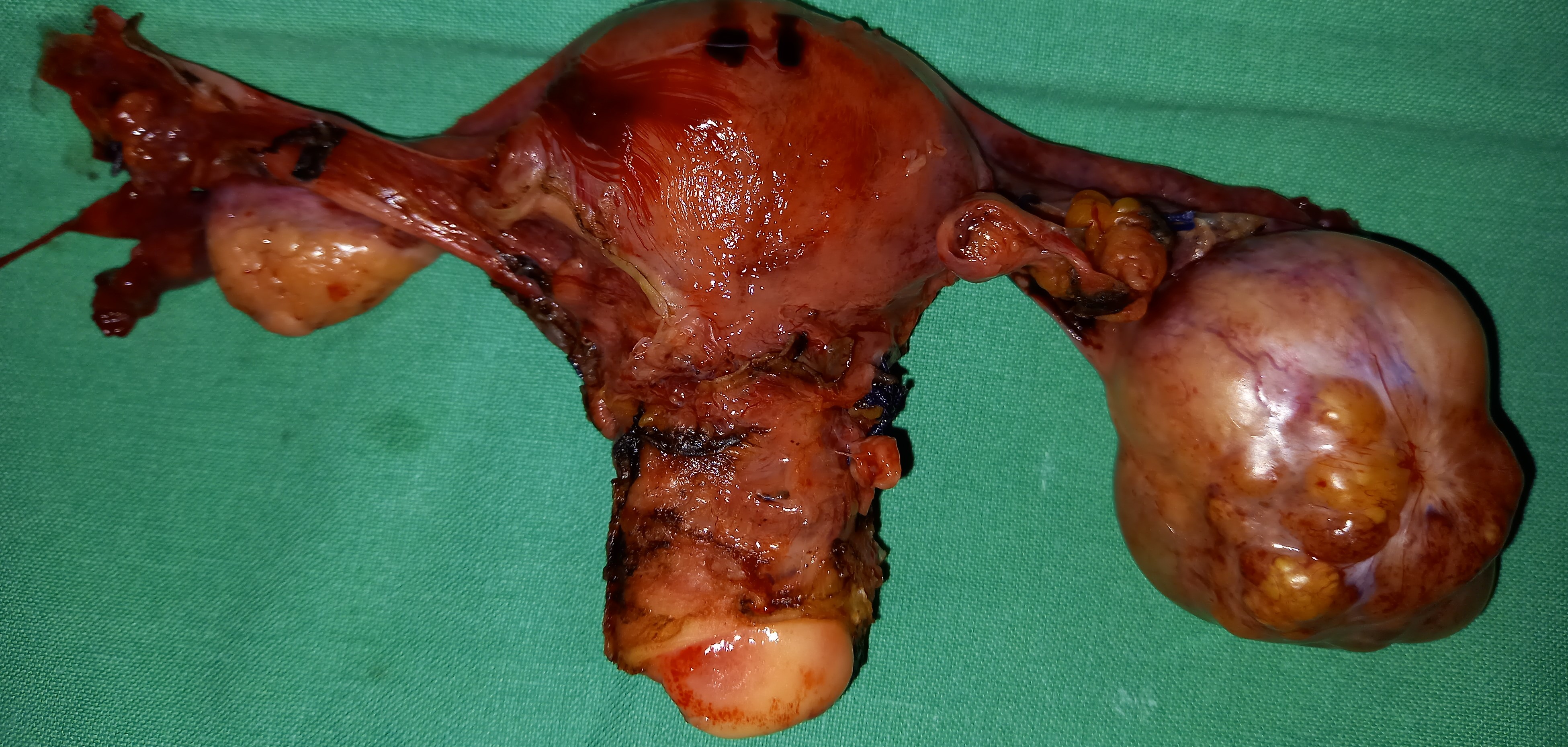TOTAL HYSTERECTOMY