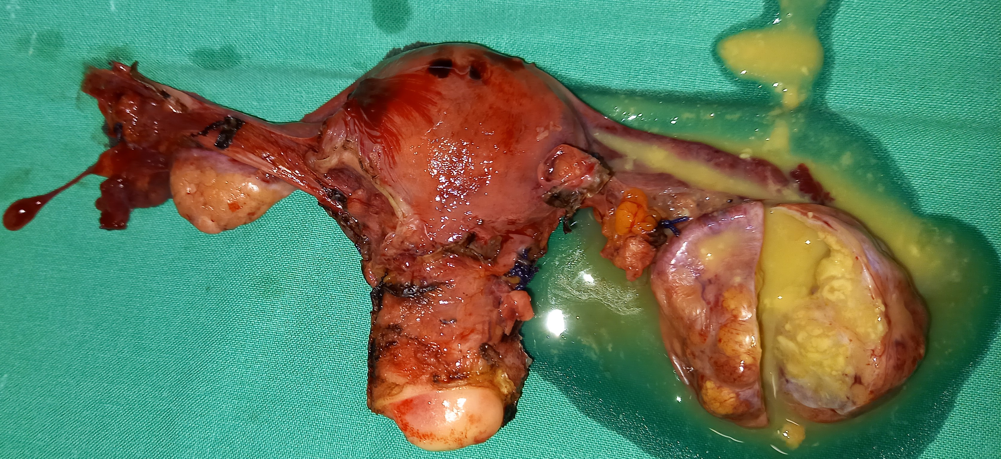 TOTAL HYSTERECTOMY