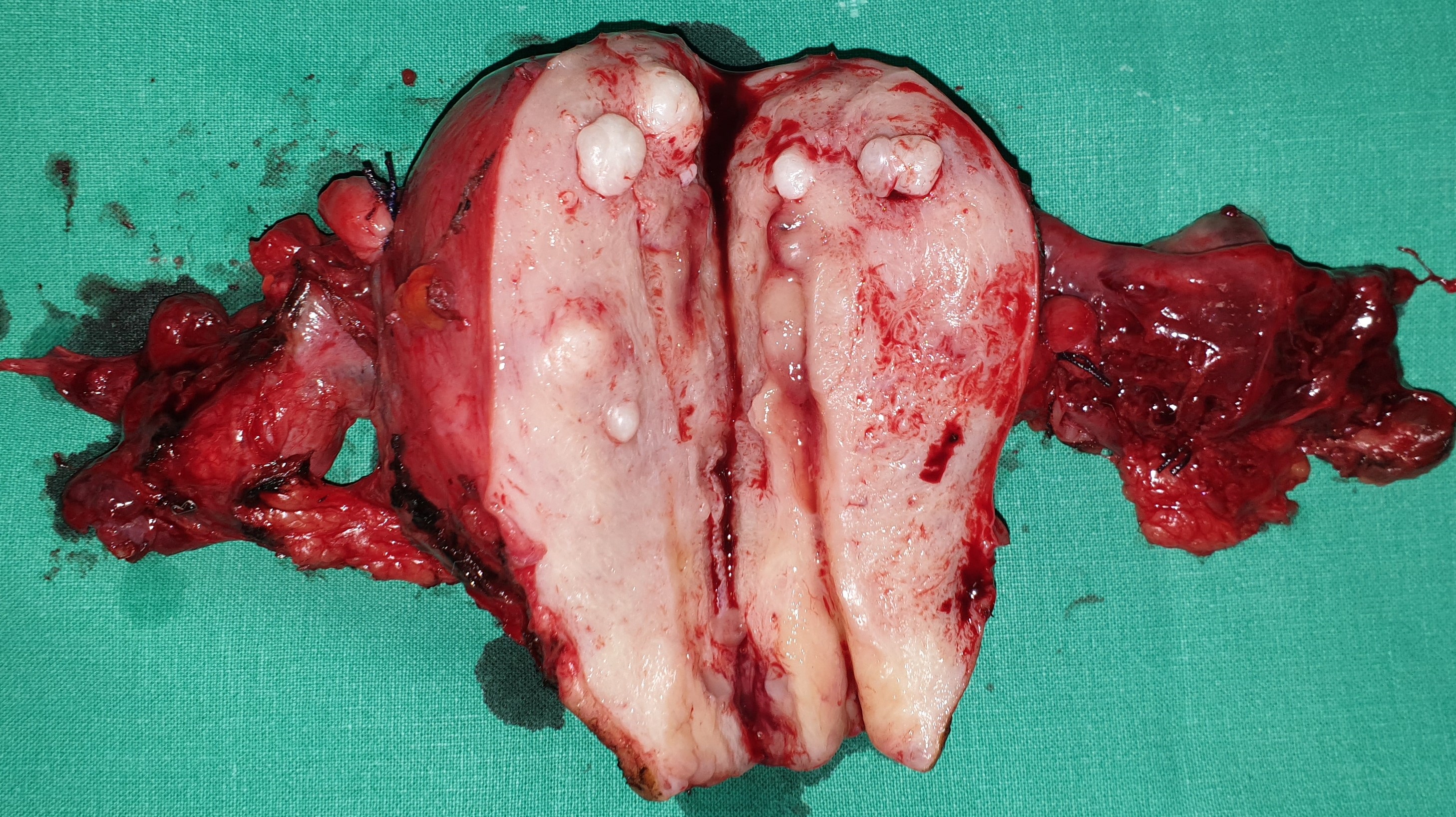 TOTAL HYSTERECTOMY