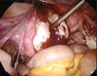 OVARIAN ENDOMETRIOMA