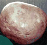 SIZEABLE OVARIAN CYST