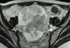 CLEAR CELL OVARIAN CARCINOMA