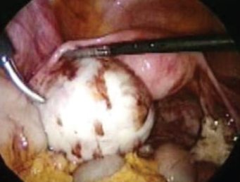 OVARIAN ENDOMETRIOMA
