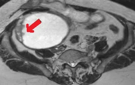OVARIAN TERATOMA - MALIGNANT TRANSFORMATION
