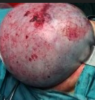 OVARIAN CYST