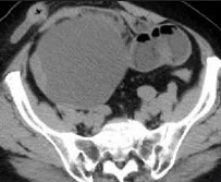 OVARIAN TERATOMA - MALIGNANT TRANSFORMATION