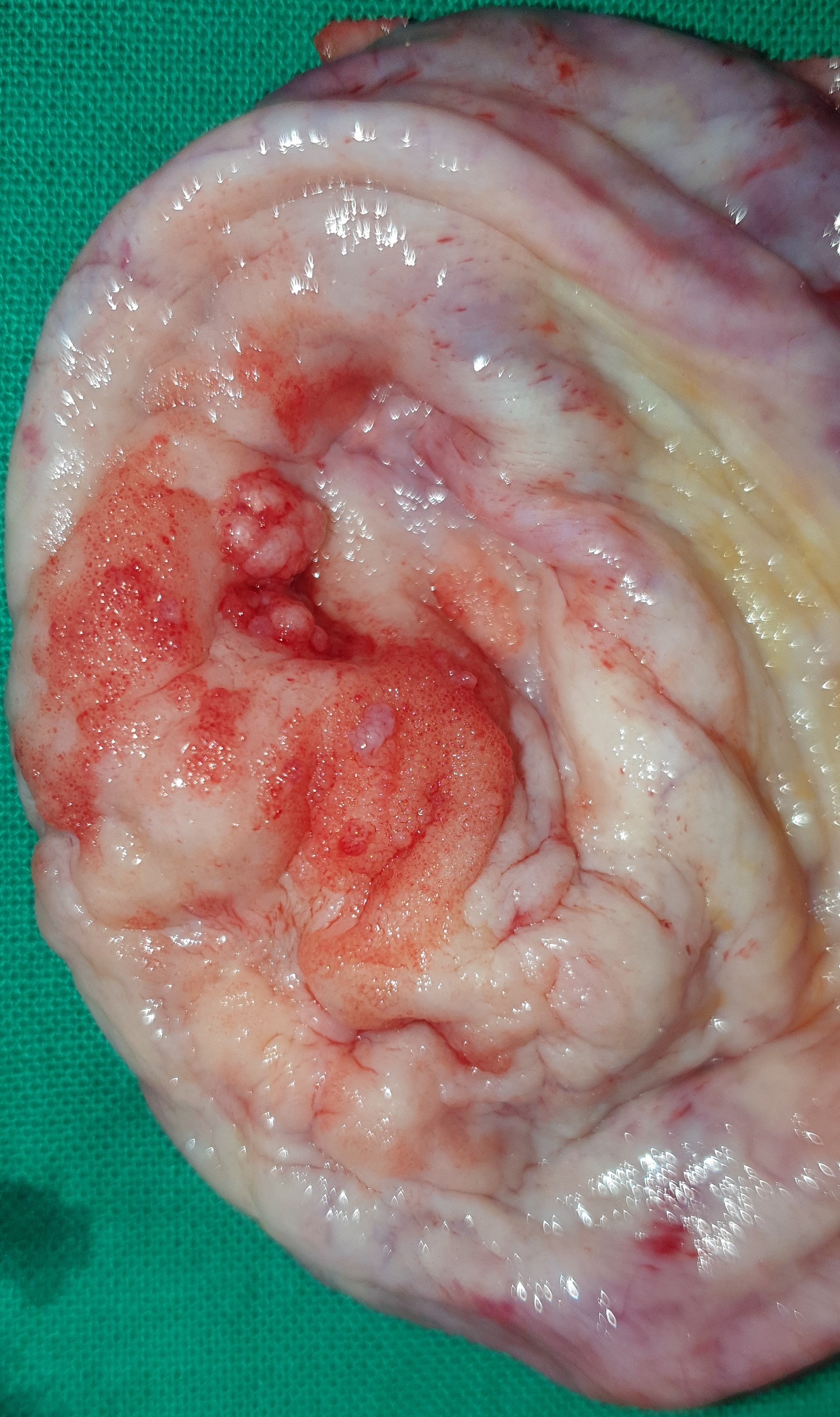 OVARIAN CYST