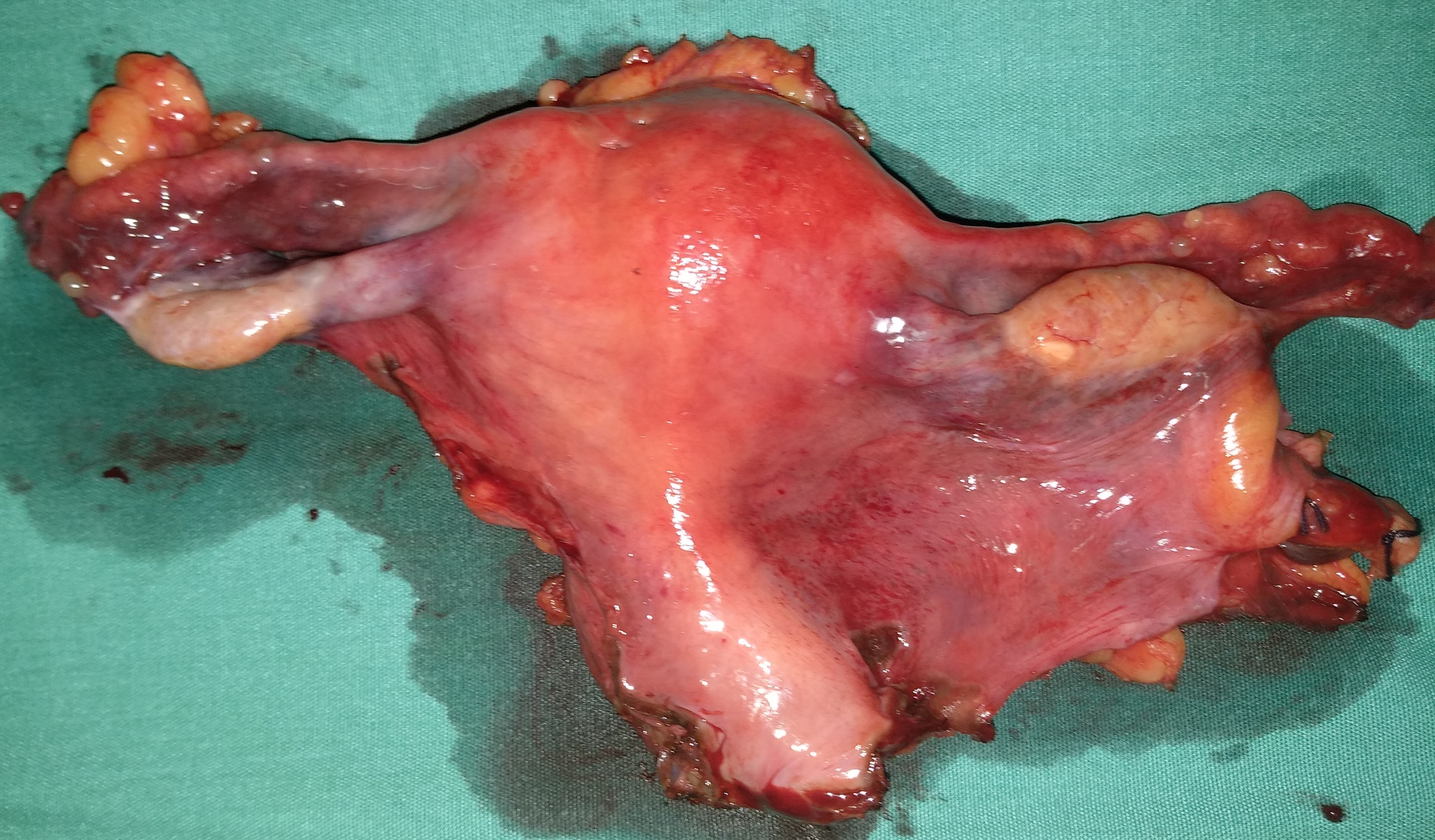 TOTAL HYSTERECTOMY