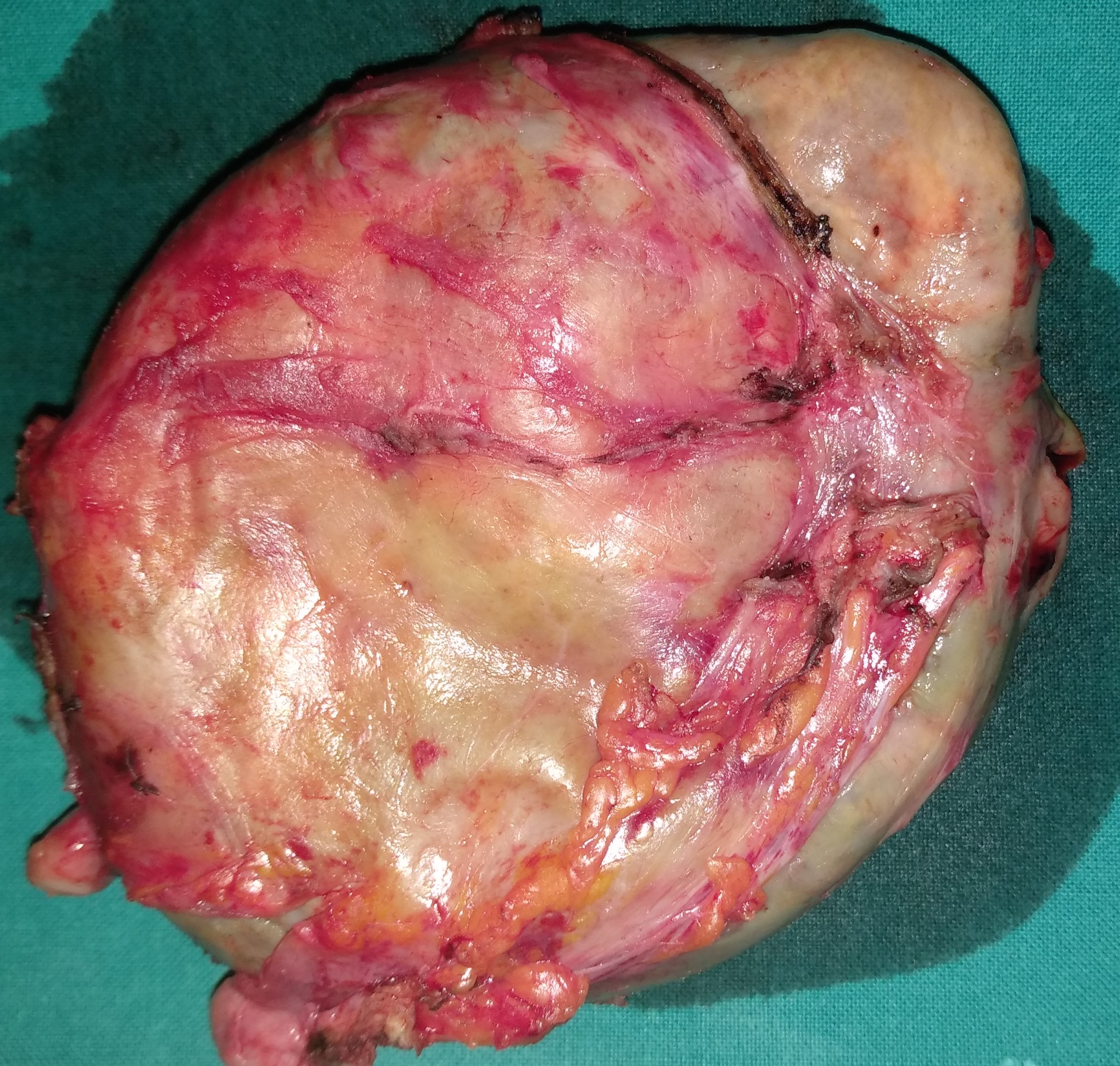 OVARIAN CARCINOMA